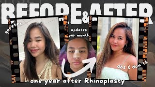 My Rhinoplasty Journey EP3 1 year update since my operation journey to recovery  Milleyjn Aira [upl. by Prudy753]