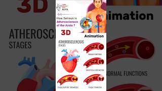 Atherosclerosis animation  medical animation 3d short BiologywithAliya [upl. by Gnouhp552]