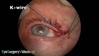 Lester Jones Tube Insertion Post Medial Canthal Tumour Excision [upl. by Naji]