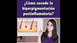 ¿Cómo sucede la hiperpigmentación postinflamatoria👩🏻‍⚕️ l Dra Pau Zúñiga CLIPS [upl. by Adnawt]