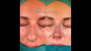 Nose Tip Surgery  Closed Rhinoplasty [upl. by Denney393]