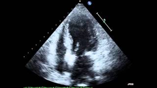 Takotsubo Cardiomyopathy Echocardiogram [upl. by Aker]