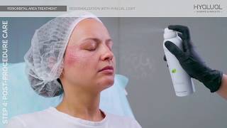 PERIORBITAL AREA TREATMENT Redermalization with Hyalual Light [upl. by Mirielle]