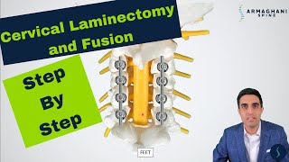 Posterior Cervical Laminectomy and Fusion  Procedure details recovery and expectations [upl. by Karlyn968]