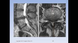 Lumbar Spinal Stenosis Cauda Equina Syndrome Sciatica amp Disc Herniation An Advanced Lecture [upl. by Victory480]