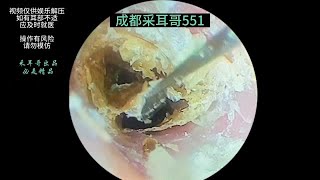 采耳哥Thick and dry slices of external auditory meatusearwax asmr drzhao ｜551 [upl. by Partridge]