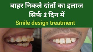 बाहर निकले दांतों का इलाज सिर्फ 2 दिन में  Smile design treatment fluorosis treatment Smile [upl. by Orville]