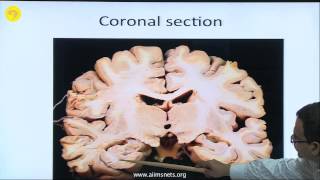 Surgical anatomy of ventricles of the brain [upl. by Anhsirk22]