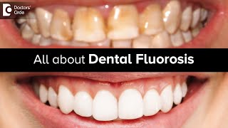 All about Dental Fluorosis  Tooth Discolouration  Tooth Colour Dr Lahari ASR  Doctors Circle [upl. by Eugenle]