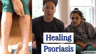 How Megha From Keto Connect Could Heal Her PsoriasisThe CarnivoreKeto Diet Heals Autoimmune Issues [upl. by Mossberg]