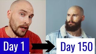 5 MONTH MINOXIDIL BEARD TRANSFORMATION [upl. by Odell540]