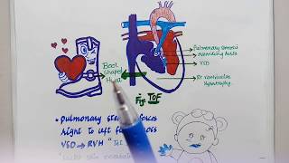 What are congenital heart defects What is ASDVSDPDA Tetralogy of fallot coarctaction of aorta [upl. by Lyman]