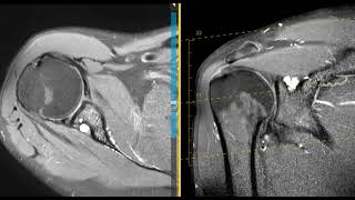 Shoulder pain from labral tear with paralabral cyst [upl. by Nylinnej]