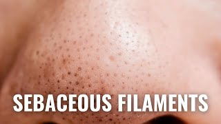 How To Get Rid of Sebaceous Filaments QUICKLY [upl. by Leupold]