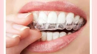 Braces vs Aligners Overview with Aligners Case Presentation and correction shown in Video [upl. by Power]