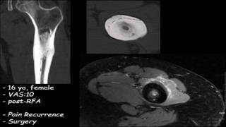 Maayan Kimhy  MRgFUS Treatment of Osteoid Osteoma a Prospective Development Study 2016 [upl. by Zurek338]