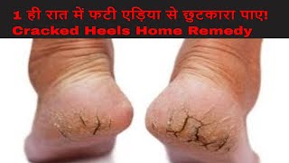 1 ही रात में फटी एड़िया से छुटकारा पाए Cracked Heels Home Remedy  Cracked Heels Treatment [upl. by Mead]