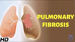 Pulmonary Fibrosis Everything You Need To Know [upl. by Rinum918]