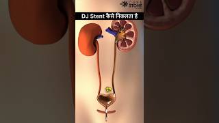 DJ Stent Removal  Retrograde Intrarenal Surgery  kidney stone treatment shorts [upl. by Dynah]