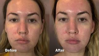 Cryoskin 30 Toning Facial at Deify Laser  Beauty Lounge [upl. by Analart633]