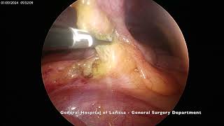 Epiploic Appendagitis [upl. by Patterman888]