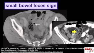 CT Imaging Small Bowel Obstruction SBO [upl. by Billy937]