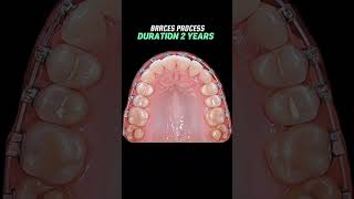 Braces process 2year braces orthodontist niengrang dentist [upl. by Raymond248]