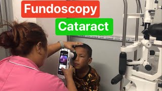 Fundoscopy  Retina  Congenital Cataract [upl. by Lilah]