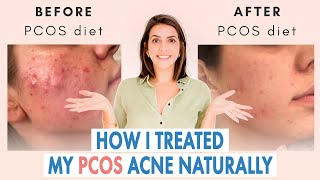 How I Healed My Cystic Acne NATURALLY PCOS amp Hormonal Acne [upl. by Ardiedal]