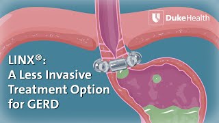 Using LINX® to Treat GERD  Duke Health [upl. by Ramah50]