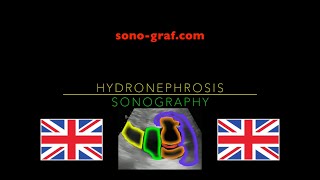 Sonography  Hydronephrosis [upl. by Yerocaj]