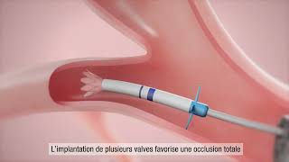 La valve endobronchique Zephyr® pour les personnes atteintes de BPCO et demphysème Français [upl. by Jeralee943]