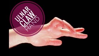 ULNAR CLAW HAND [upl. by Amaryllis]