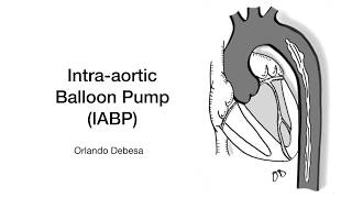 IntraAortic Balloon Pump [upl. by Calvinna]