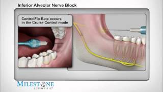 Inferior Alveolar Nerve Block [upl. by Ahsirt]