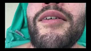 Voice DeepeningMasculinization Surgery [upl. by Watters890]