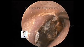 Cleaning of cerumen embolism in children and adults8mins20230114 [upl. by Aileno]