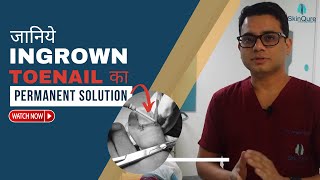 Ingrown Toenail Surgery  Nail Surgery Clinic in Delhi Ingrown Toenail Removal in Delhi SkinQure [upl. by Deutsch]