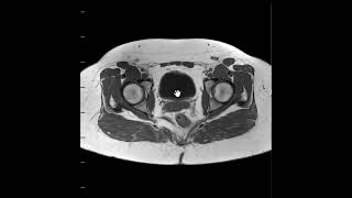 Ischiofemoral impingement [upl. by Edas]