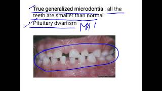 Microdontia [upl. by Cristen]