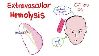 Extravascular Hemolysis [upl. by Henrietta]