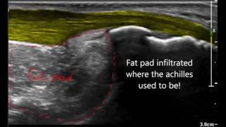 Haglund deformity versus haglund syndrome [upl. by Remington783]