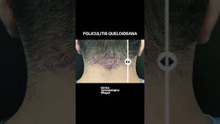 Foliculitis Queloideana [upl. by Ibmab261]