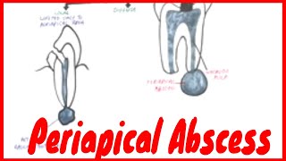 Periapical Abscess Causes Symptoms amp Treatment [upl. by Chara]