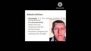 Acromegaly physiotherapy physiology youtube shorts [upl. by Drahnreb296]