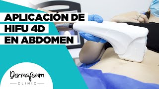 APLICACIÓN DE HIFU 4D EN ABDOMEN  Combate la flacidez [upl. by Ecylla]