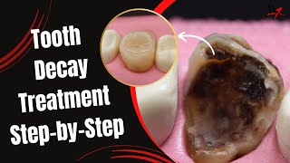 Restoration of a Massive Tooth Decay [upl. by Lisabeth]