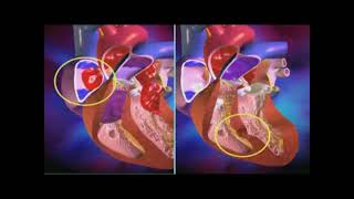 Cardiopathie congénitale [upl. by Giacamo]