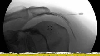 Inadvertent Deltoid Muscle Injection under Fluoroscopy  ThePainSourcecom [upl. by Ytsirhc895]