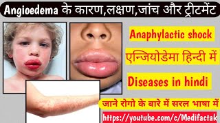 Angioedema के कारणलक्षणजॉंच और ट्रीटमेंटanaphylactic shock [upl. by Ahsinak]